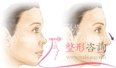 <a href=http://www.f3bb6.cn/listinfo-758-0.html target=_blank class=infotextkey>朝天鼻矯正</a>術