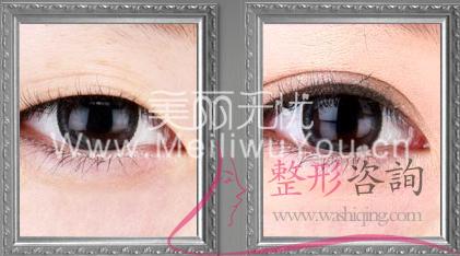 割<a href=http://www.f3bb6.cn/listinfo-724-0.html target=_blank class=infotextkey>雙眼皮</a>手術