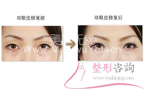 <a href=http://www.f3bb6.cn/listinfo-724-0.html target=_blank class=infotextkey>雙眼皮</a>修復