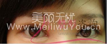 割開法<a href=http://www.f3bb6.cn/listinfo-724-0.html target=_blank class=infotextkey>雙眼皮</a>