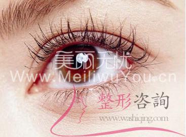 <a href=http://www.f3bb6.cn/listinfo-724-0.html target=_blank class=infotextkey>雙眼皮</a>手術