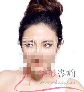 割<a href=http://www.f3bb6.cn/listinfo-724-0.html target=_blank class=infotextkey>雙眼皮</a>