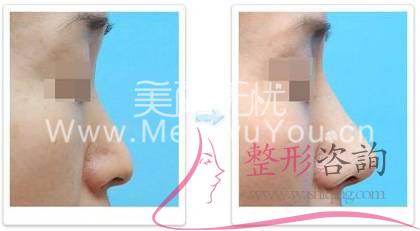 <a href=http://www.f3bb6.cn/listinfo-737-0.html target=_blank class=infotextkey>隆鼻</a>