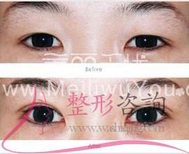 消融手術<a href=http://www.f3bb6.cn/listinfo-724-0.html target=_blank class=infotextkey>雙眼皮</a>