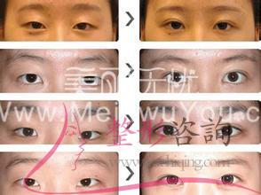消融手術<a href=http://www.f3bb6.cn/listinfo-724-0.html target=_blank class=infotextkey>雙眼皮</a>