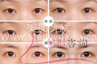 消融手術<a href=http://www.f3bb6.cn/listinfo-724-0.html target=_blank class=infotextkey>雙眼皮</a>