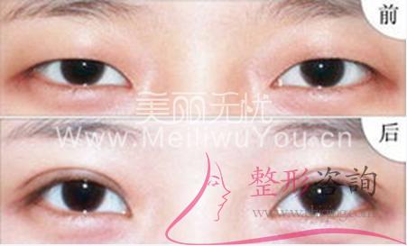 <a href=http://www.f3bb6.cn/listinfo-724-0.html target=_blank class=infotextkey>雙眼皮</a>