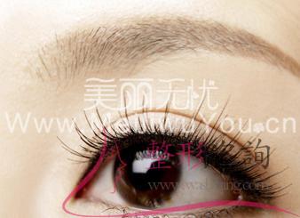 單眼皮,<a href=http://www.f3bb6.cn/listinfo-724-0.html target=_blank class=infotextkey>雙眼皮</a>