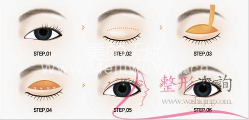 割開割<a href=http://www.f3bb6.cn/listinfo-724-0.html target=_blank class=infotextkey>雙眼皮</a>手術