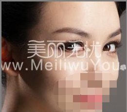 微創<a href=http://www.f3bb6.cn/listinfo-724-0.html target=_blank class=infotextkey>雙眼皮</a>手術治療治療