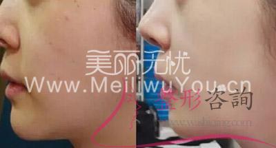 打<a href=http://www.f3bb6.cn/listinfo-790-0.html target=_blank class=infotextkey>水光針</a>