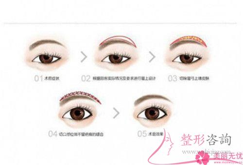 一次皮秒激光<a href=http://www.f3bb6.cn/listinfo-658-0.html target=_blank class=infotextkey>洗眉</a>能夠清潔凈紋眉嗎