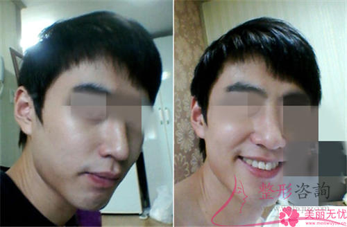 單純假體<a href=http://www.f3bb6.cn/listinfo-737-0.html target=_blank class=infotextkey>隆鼻</a>之后應(yīng)該如何防患病毒感染