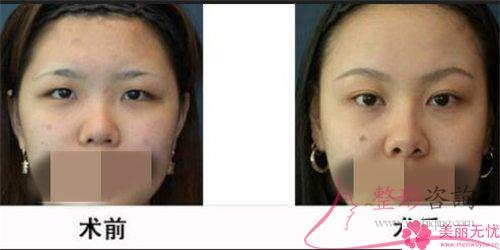 受術者是否能承擔實行種眉毛的價格