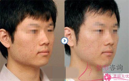 各位朋友著實知曉下頜部醫療整形嗎