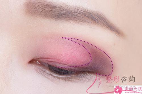 5970塊錢能夠實施激光去除黑眼圈嗎