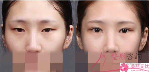 開內眼角后應該怎么護理比較好？留下線頭如何是好？