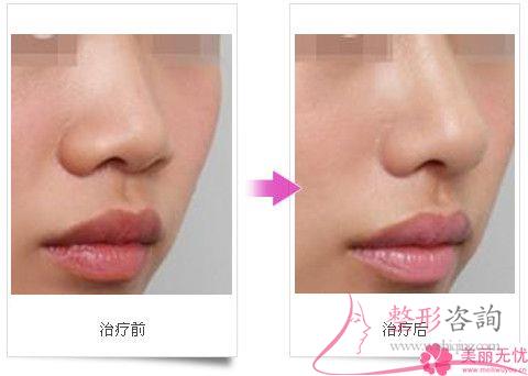 最好預備幾千塊就可實施抬高鼻梁