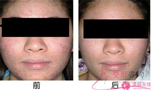 激光磨皮去痘坑能否達到無創修整