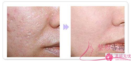 激光磨皮去痘坑能否達到無創修整