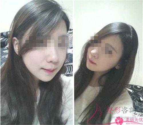 臉部皮膚發生褶子選用冰電波<a href=http://www.f3bb6.cn/listinfo-614-0.html target=_blank class=infotextkey>除皺</a>術管用嗎？