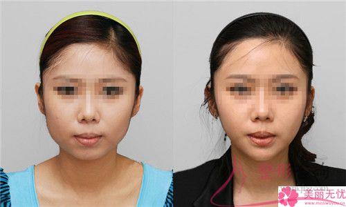 臉部皮膚發生褶子選用冰電波<a href=http://www.f3bb6.cn/listinfo-614-0.html target=_blank class=infotextkey>除皺</a>術管用嗎？