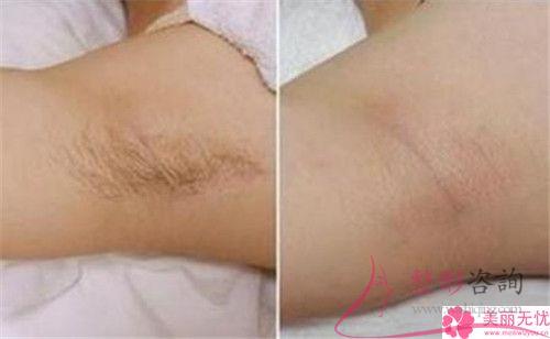 進(jìn)行一次冰點(diǎn)永久<a href=http://www.f3bb6.cn/listinfo-670-0.html target=_blank class=infotextkey>脫毛</a>花費(fèi)要多少