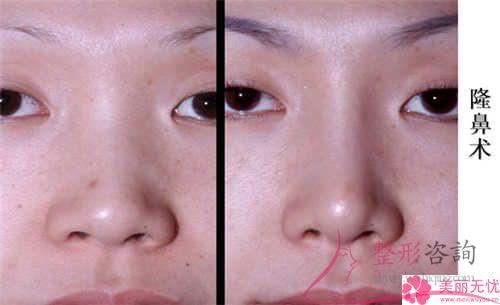 假體硅膠<a href=http://www.f3bb6.cn/listinfo-737-0.html target=_blank class=infotextkey>隆鼻</a>成效能維持好久?得住院?jiǎn)幔? /></p><p>挺立的鼻子能提高1個(gè)女性的整體形象,所以一些鼻梁低平的妹紙們想實(shí)施硅膠<strong><a href=http://www.f3bb6.cn/listinfo-737-0.html target=_blank class=infotextkey>隆鼻</a>整形</strong>術(shù)來(lái)完成立體感,硅膠<a href=http://www.f3bb6.cn/listinfo-737-0.html target=_blank class=infotextkey>隆鼻</a>整形術(shù)是一個(gè)現(xiàn)代化的醫(yī)療水平,術(shù)后結(jié)果更天然,可是之后維持時(shí)間是一有必要關(guān)心的難題。那麼,如何加強(qiáng)硅膠<a href=http://www.f3bb6.cn/listinfo-737-0.html target=_blank class=infotextkey>隆鼻</a>后的保養(yǎng)技巧?</p><p style=