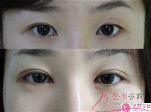 激光<a href=http://www.f3bb6.cn/listinfo-658-0.html target=_blank class=infotextkey>洗眉</a>毛術前術后對比效果怎樣？3307元能做嗎