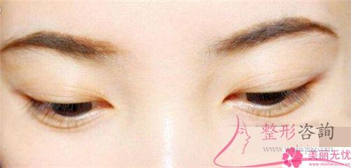 可以采用聚乙烯、聚四氟乙烯人工合成代品<a href=http://www.f3bb6.cn/listinfo-654-0.html target=_blank class=infotextkey>隆眉弓</a>嗎