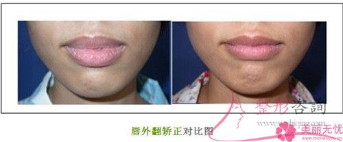唇外翻幾歲矯正合適