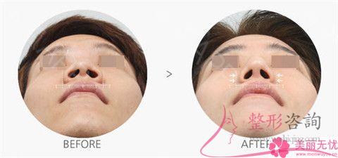 <a href=http://www.f3bb6.cn/listinfo-754-0.html target=_blank class=infotextkey>鼻翼</a>整形后萬一再次外擴怎么辦