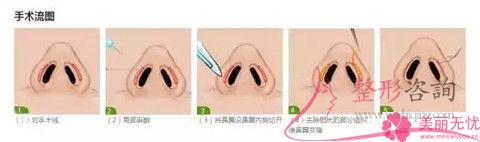 <a href=http://www.f3bb6.cn/listinfo-754-0.html target=_blank class=infotextkey>鼻翼</a>整形后萬一再次外擴怎么辦