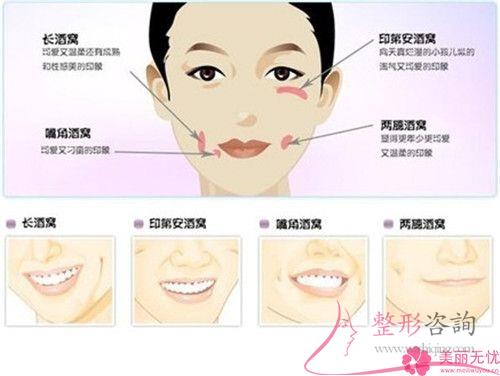 想要笑起來有酒窩，哪些手術方法可以形成酒窩