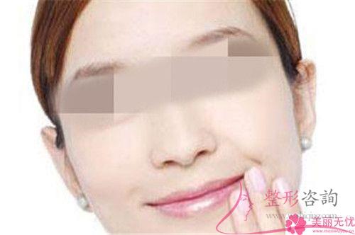 想要笑起來有酒窩，哪些手術方法可以形成酒窩