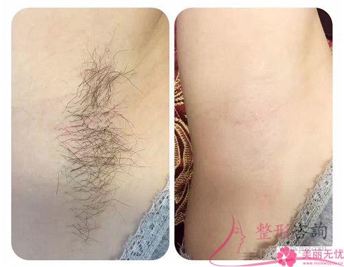 <a href=http://www.f3bb6.cn/listinfo-685-0.html target=_blank class=infotextkey>吸脂</a><a href=http://www.f3bb6.cn/listinfo-680-0.html target=_blank class=infotextkey>瘦背</a>部大概需要花費多少錢