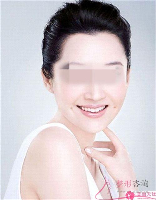 酒窩成形有幾種類型