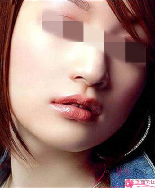 <a href=http://www.f3bb6.cn/listinfo-629-0.html target=_blank class=infotextkey>下頜角</a>整形做完會不會臉部皮膚松垂