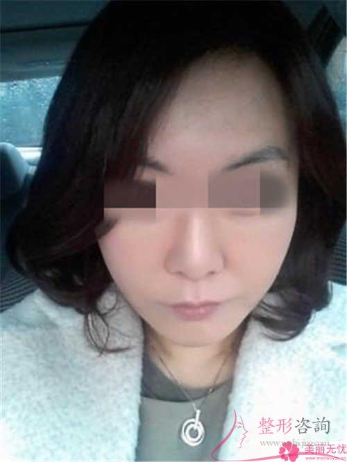 具體哪種填充<a href=http://www.f3bb6.cn/listinfo-614-0.html target=_blank class=infotextkey>除皺</a>措施適用于32歲的小伙伴們