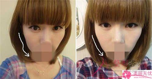 冰電波<a href=http://www.f3bb6.cn/listinfo-614-0.html target=_blank class=infotextkey>除皺</a>整形術除能<a href=http://www.f3bb6.cn/listinfo-614-0.html target=_blank class=infotextkey>除皺</a>還哪些效果？