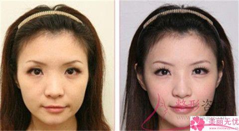 實施復合彩光<a href=http://www.f3bb6.cn/listinfo-770-0.html target=_blank class=infotextkey>嫩膚</a>終止會怎么樣？會復發嗎？