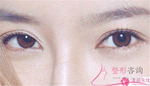 成都實(shí)施無(wú)痕<a href=http://www.f3bb6.cn/listinfo-711-0.html target=_blank class=infotextkey>開眼角</a>術(shù)花多少錢？貴么