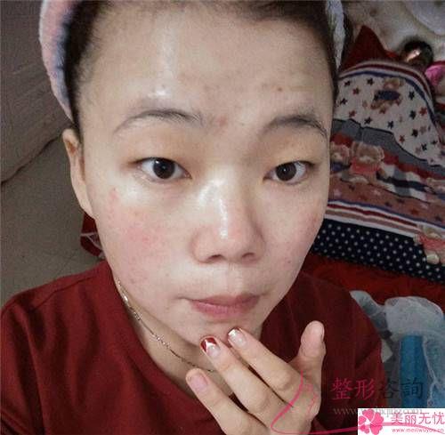 激光磨皮除痘痘有什么優勢？瘢痕體質可以實行嗎