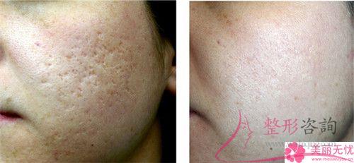 激光磨皮除痘痘有什么優勢？瘢痕體質可以實行嗎