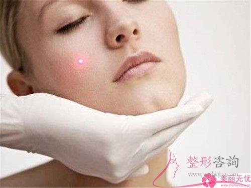 用激光熱能點(diǎn)痣需多少錢一次