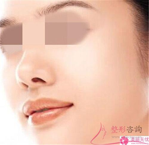 用激光熱能點(diǎn)痣需多少錢一次