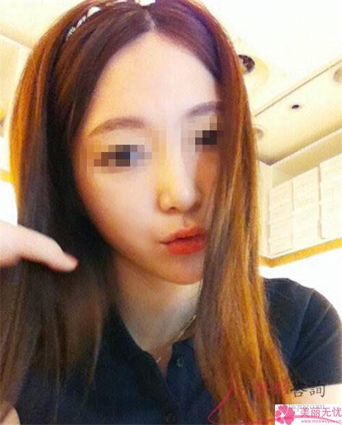 磨骨<a href=http://www.f3bb6.cn/listinfo-631-0.html target=_blank class=infotextkey>瘦臉</a>改臉型幾乎要好長時(shí)間還原，該怎么調(diào)理