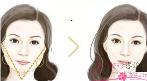 磨骨<a href=http://www.f3bb6.cn/listinfo-631-0.html target=_blank class=infotextkey>瘦臉</a>改臉型幾乎要好長時(shí)間還原，該怎么調(diào)理