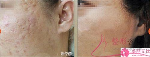 紅光與藍(lán)光祛痘存在一些什么優(yōu)點(diǎn)