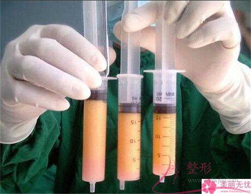 線雕提升術去除鼻唇溝皺紋貴嗎？多少元